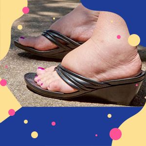 Почему летом опухают ноги?